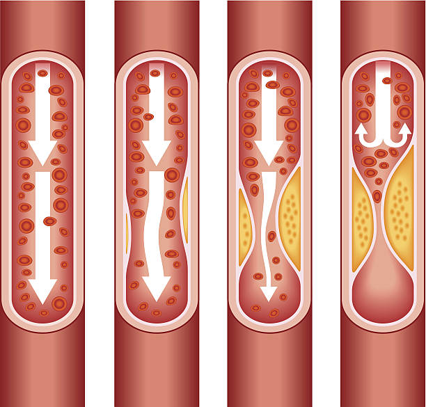 ludzka miażdżyca tętnic - human artery cholesterol atherosclerosis human heart stock illustrations