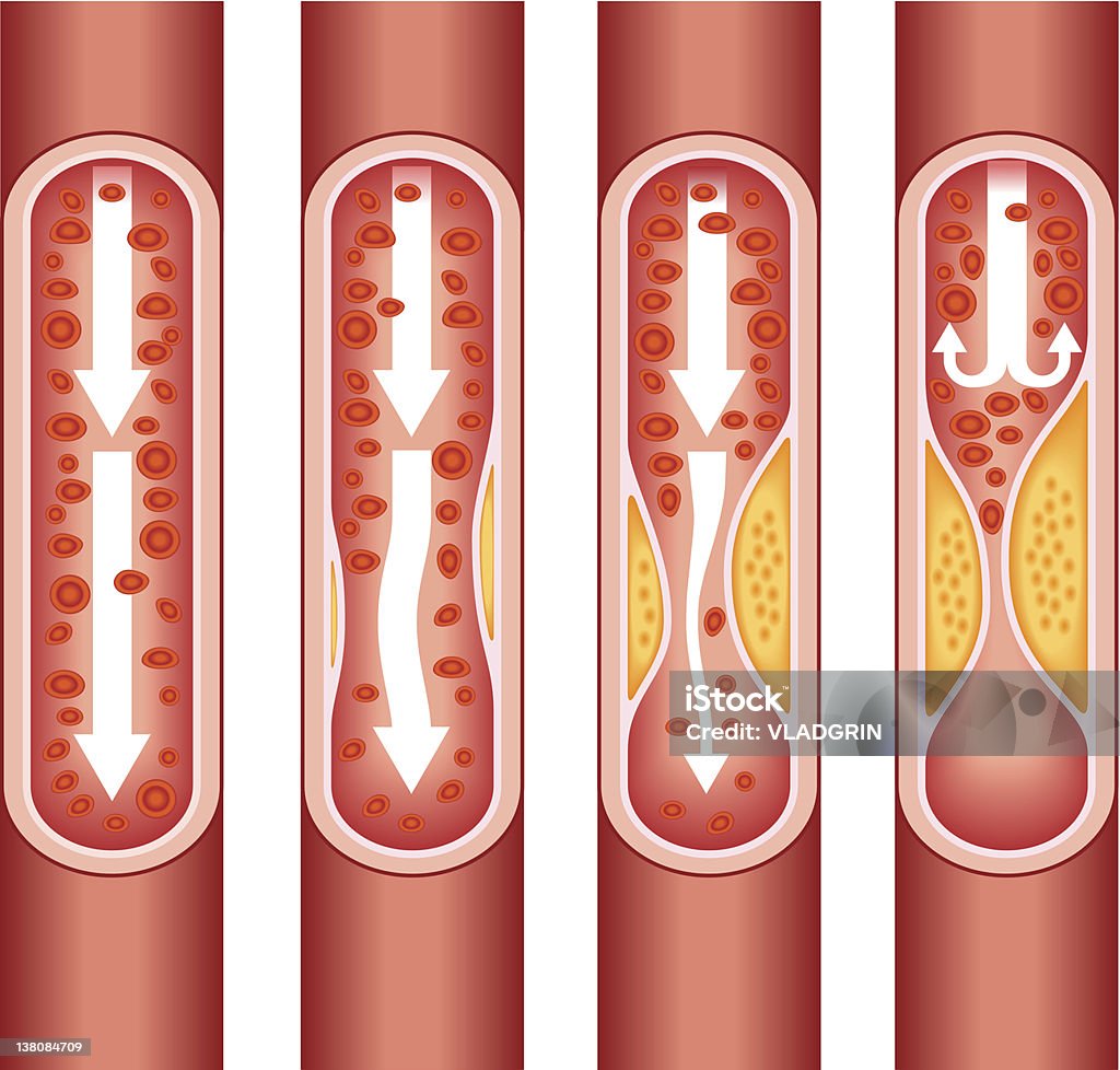 Атеросклероз человека - Векторная графика Атеросклероз роялти-фри
