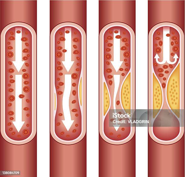 Атеросклероз Человека — стоковая векторная графика и другие изображения на тему Атеросклероз - Атеросклероз, Кровеносный сосуд, Закупорка