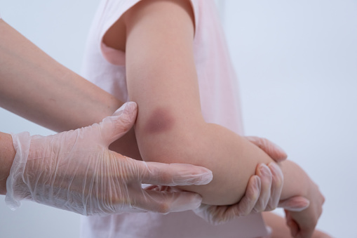 The doctor palpates the child's elbow. The traumatologist examines the site of injury. There is a bruise on the child's arm. Elbow injury.