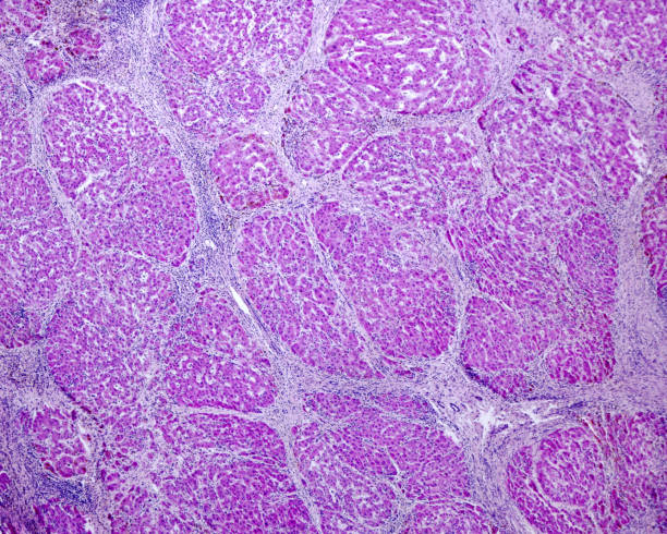istock Human liver. Cirrhosis. Glycogen 1382278701