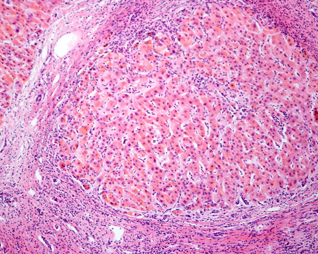 Human liver. Cirrhosis. The micrograph shows a regenerating nodule of hepatocytes with brown bile pigment surrounded by connective tissue septa with chronic inflammatory infiltrates.