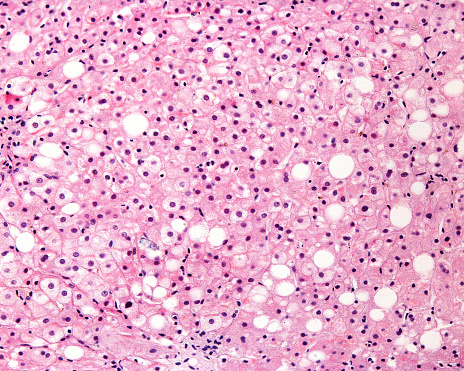 Light micrograph of a human liver affected by macrovesicular steatosis (fatty degeneration). Many hepatocytes show a big single fat droplet that pushes the nucleus and cytoplasm to the periphery of the cell.