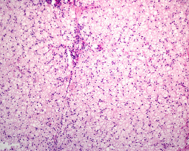 Glycogen Storage Disease Bilder und Stockfotos iStock