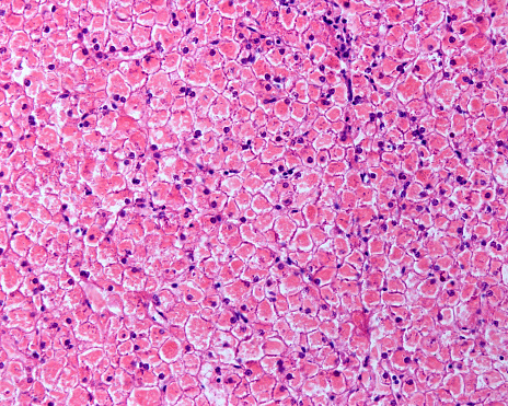 Human liver. Hepatic glycogenosis. After conventional tissue preparation (fixation by formaldehyde-and staining with haematoxylin and eosin) the glycogen is usually removed from the hepatocytes. Using an alcoholic fixative, the glycogen is preserved, appearing as a pink material that fills the hepatocytes. The accentuation of the cell membranes and displacement of the nuclei to the cell periphery still can be seen.