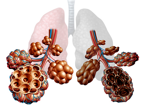 Emphysema as shortness of breath, lung disorder as a COPD illness and Chronic obstructive pulmonary disease medical concept as bronchioles and alveoli are damaged as a 3D illustration.