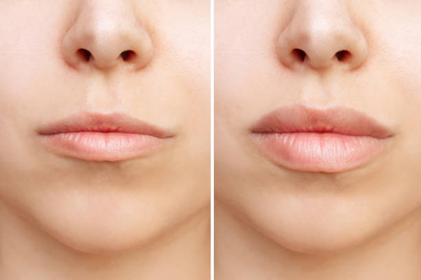 cropped aufnahme des unteren gesichtsteils der jungen frau mit lippen vor und nach der lippenvergrößerung - big lips stock-fotos und bilder