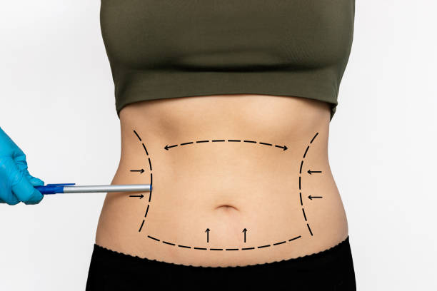 woman's lined belly with excess fat and doctor's gloved hand pointing on marking stomach with a pen - liposuction imagens e fotografias de stock