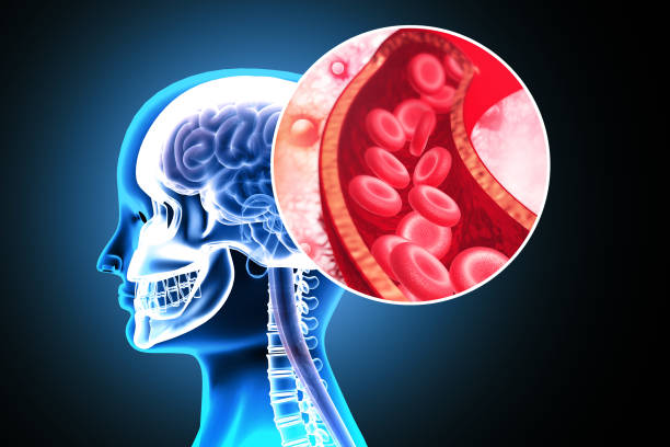 accidente cerebrovascular aterosclerosis. un coágulo de sangre en los vasos del cerebro humano. ilustración 3d - flujo sanguíneo fotografías e imágenes de stock