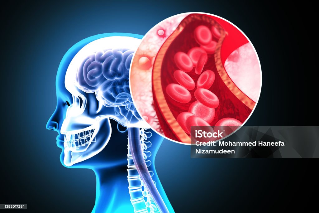 Atherosclerosis Stroke. A blood clot in the vessels of the human brain. 3d illustration Stroke - Illness Stock Photo
