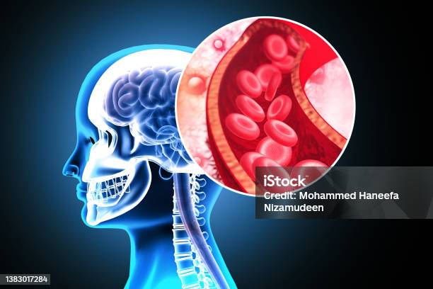 Atherosclerosis Stroke A Blood Clot In The Vessels Of The Human Brain 3d Illustration Stock Photo - Download Image Now