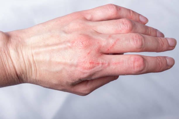 Skin condition after a cat scratch and bite. A hand scratched by a curious little kitten, a cat. Red wounds on the arm, close-up Skin condition after a cat scratch and bite. A hand scratched by a curious little kitten, a cat. Red wounds on the arm, close-up. skin scrape stock pictures, royalty-free photos & images