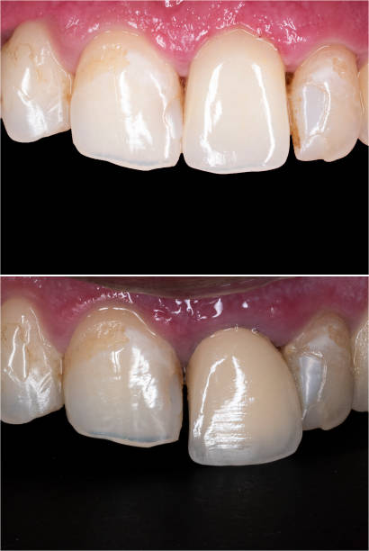 restauração de dente único por coroa porceline - veneer porceline veneers cosmetics equipment - fotografias e filmes do acervo