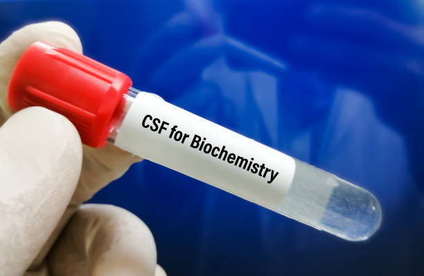 Biochemist hold Cerebrospinal fluid (CSF) sample for biochemistry test including glucose, protein, ADA Biochemist hold Cerebrospinal fluid (CSF) sample for biochemistry test including glucose, protein, ADA cerebrospinal fluid photos stock pictures, royalty-free photos & images