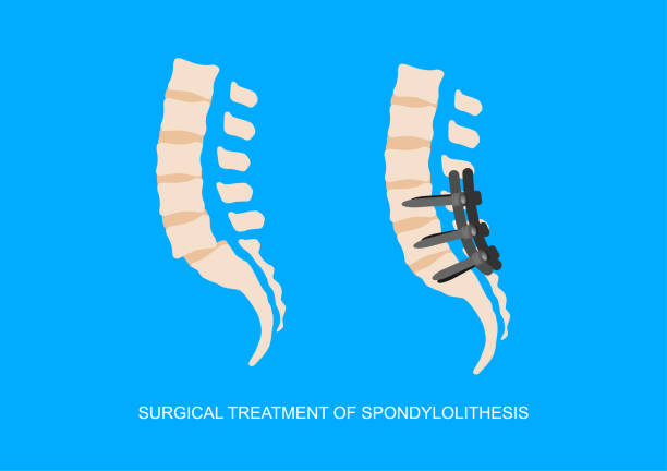 chirurgische behandlung von verrutschten lumbrosakralen wirbeln - lumbar vertebra stock-grafiken, -clipart, -cartoons und -symbole