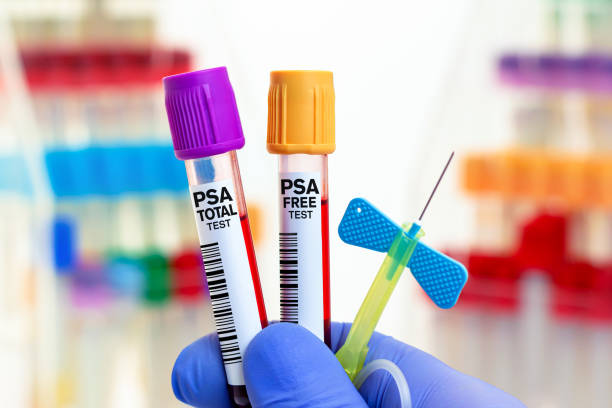 doctor with blood tubes and needle for psa free and psa total test in biochemistry lab - laboratory science healthcare and medicine centrifuge imagens e fotografias de stock