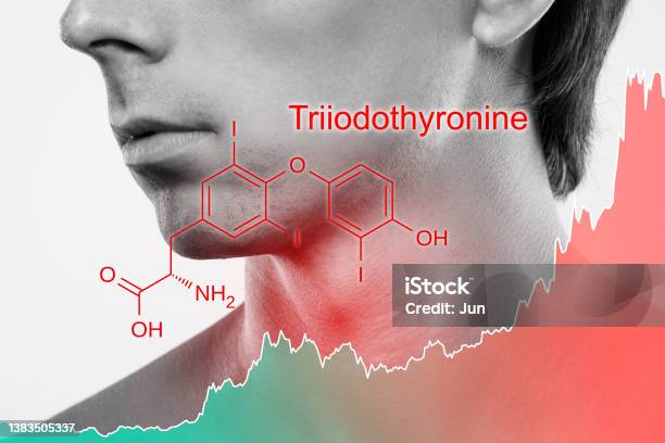 男性の首と上昇トリヨードチロニンホルモンのチャート 甲状腺機能低下症のストックフォトや画像を多数ご用意 甲状腺機能低下症, 1人