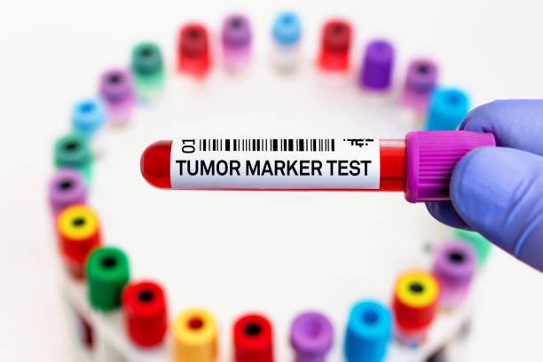 doctor with blood tube labeled with Tumor marker for analysis of cancer biomarkers test stock photo