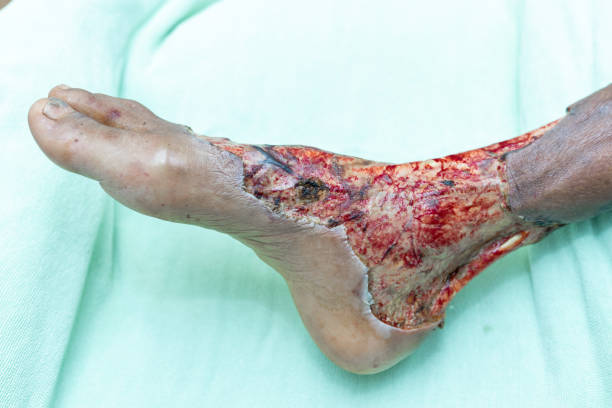 중환자실에서 치료를 받고 있는 동안 당뇨병 환자의 괴사 및 피부 외과 적 상처. - staphylococcus aureus 뉴스 사진 이미지