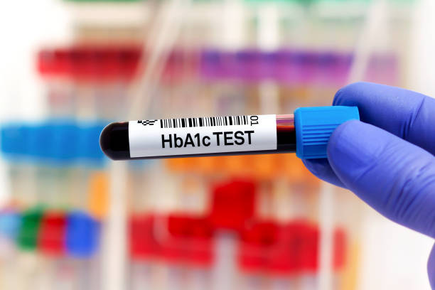 Blood sample for study of HbA1c or Hemoglobin A1c for detection of diabetes stock photo
