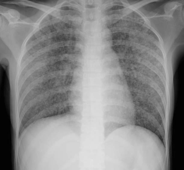miliary nodules Miliary refers to innumerable small 1-4 mm pulmonary nodules throughout the lungs. On chest radiography, the differential diagnosis of miliary pattern includes miliary tuberculosis, histoplasmosis, sarcoidosis, pneumonia, bronchoalveolar carcinoma, pulmonary siderosis, and hematogenous metastases from thyroid, kidney, and sarcoma primary cancer pulmonary nodules stock pictures, royalty-free photos & images