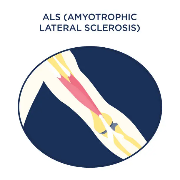 Vector illustration of ALS (Amyotrophic Lateral Sclerosis) medical icon vector drawing