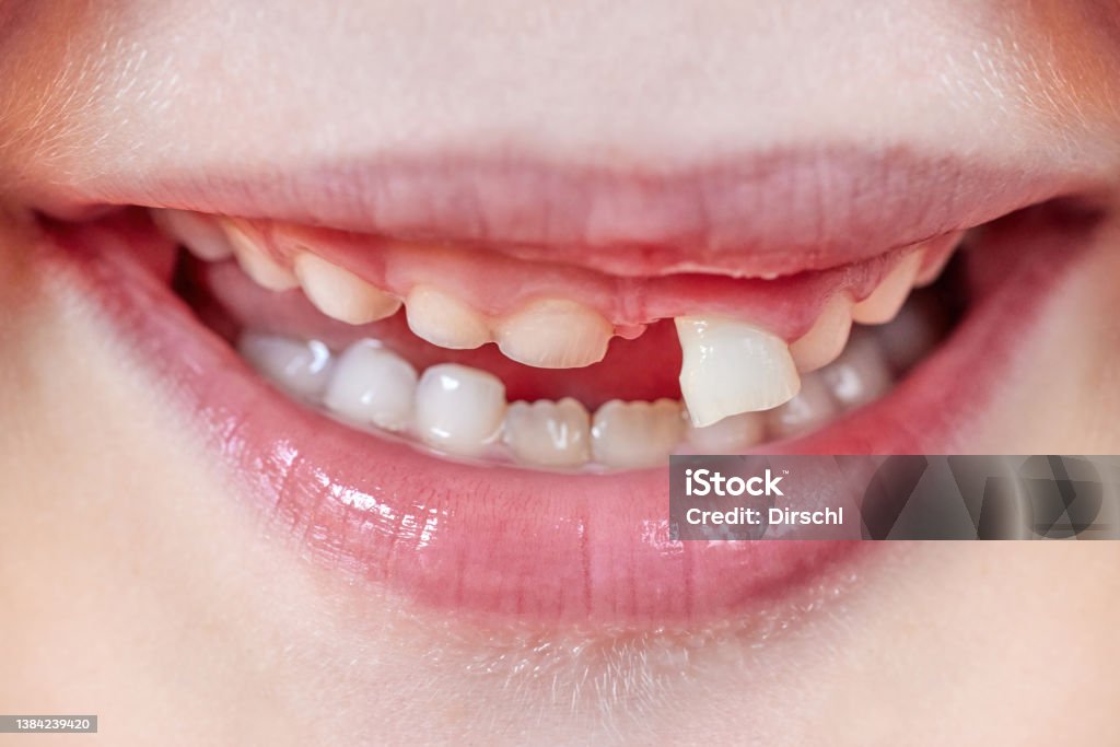 Milk Teeth Milk Tooth Before The Tooth Fairy Comes Incisor Falling Out