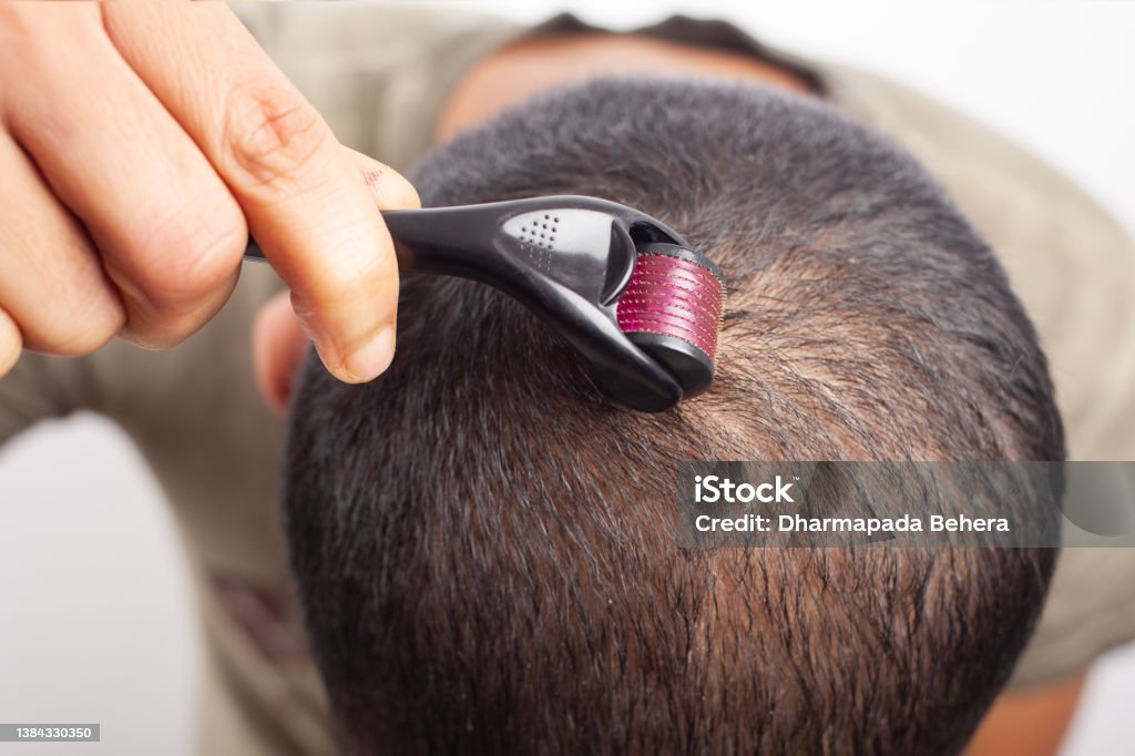 Microneedling Hair Loss Treatment For Bald Scalp To Regrow Hair Stock Photo  - Download Image Now - iStock