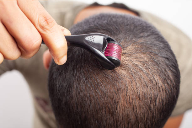 microneedling hair loss treatment for bald scalp to regrow hair A young man using dermaroller to tackle hair loss and to promote hair growth on scalp. men close up 20s asian ethnicity stock pictures, royalty-free photos & images