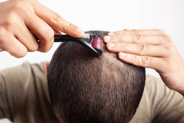 collagen induction therapy hair loss treatment - indian falls imagens e fotografias de stock