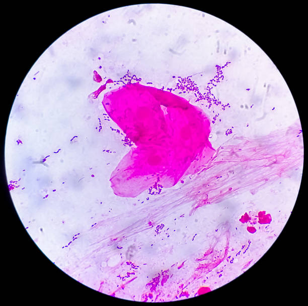 istock Gram stain: Gram positive cocci, Gram positive diplococci bacteria and squamous epithelium under microscopy 1384386403