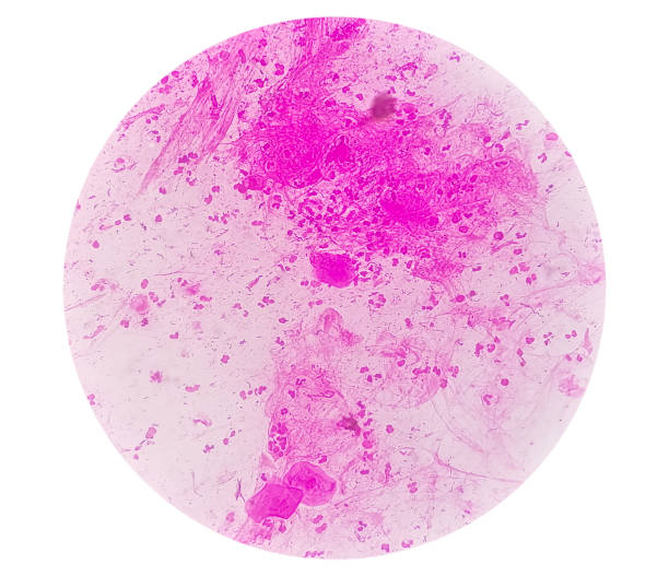 istock Gram stain: Gram positive cocci, Gram positive diplococci bacteria and squamous epithelium under microscopy 1384386410
