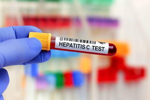 Blood sample for study of Hepatitis C Virus HCV in the lab stock photo