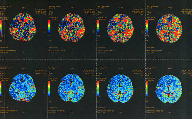 kolorowy skan mri ludzkiego mózgu - cyrkulacja zdjęcia i obrazy z banku zdjęć