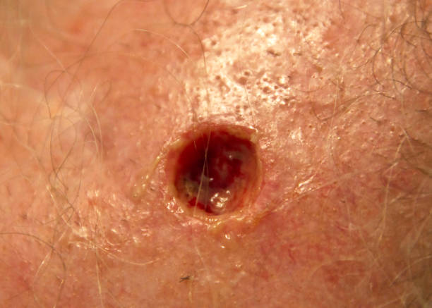mohs surgery excision of skin cancer - basalcellscancer bildbanksfoton och bilder