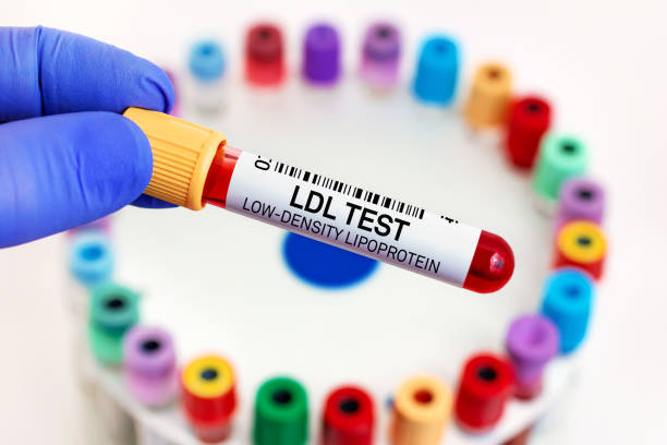doctor with Blood tube for LDL Low Density Lipoprotein test for analysis levels of cholesterol Blood sample of patient for Low Density Lipoprotein LDL test in laboratory. doctor with Blood tube for LDL Low Density Lipoprotein test for analysis levels of cholesterol cholesterol screening stock pictures, royalty-free photos & images