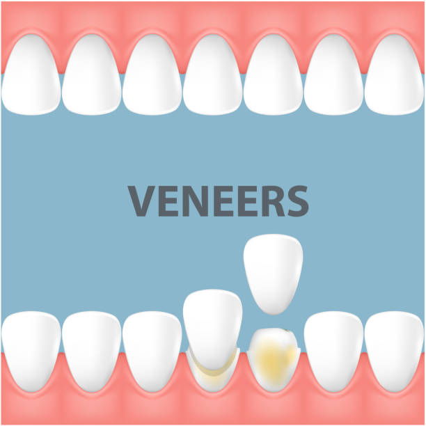 zahn- und lächeln-makeover mit zahnkeramischen veneers, reihe von vorderzähnen vor und nach der veneerabdeckung, vektor - veneer stock-grafiken, -clipart, -cartoons und -symbole