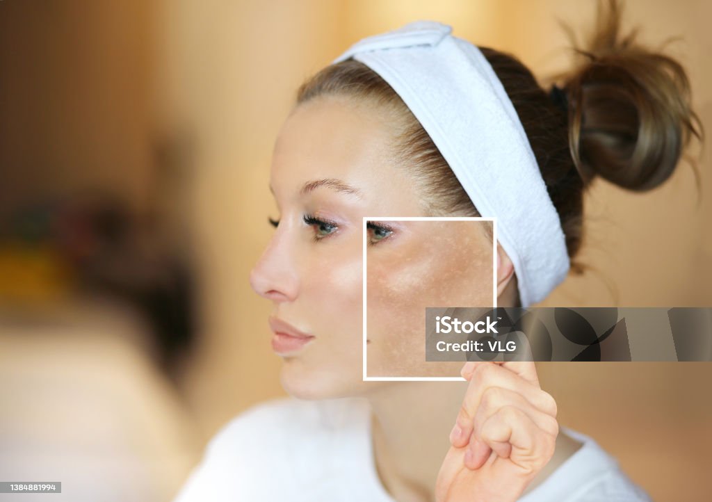 Dark spots, freckles,hyperpigmentation(melasma or chloasma),concept - skin lightening, skin whitening, fruit acids,AHA, Skin Brightening Melasma Stock Photo
