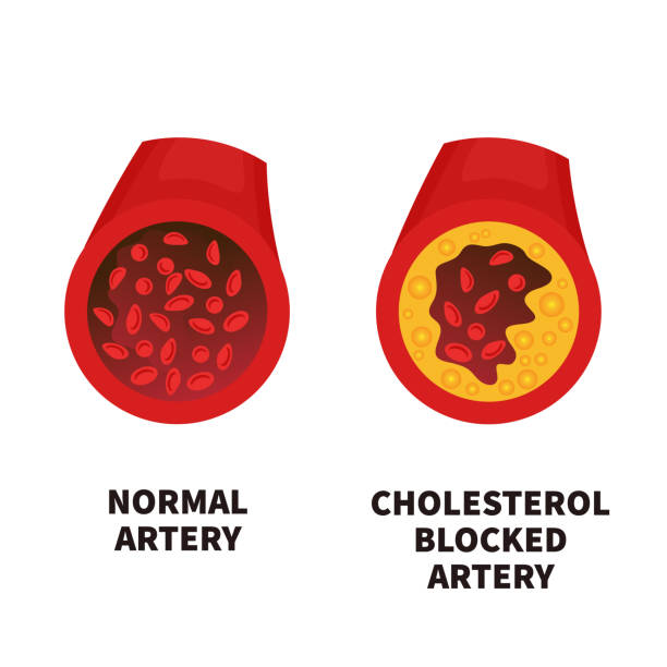 Normal and narrowed artery cross section illustration Normal blood vessel versus artery with cholesterol plaque buildup. Narrowed blood vein blocked with a clot. High cholesterol level as atherosclerotic risk. Medical concept. Vector illustration. clogged artery stock illustrations