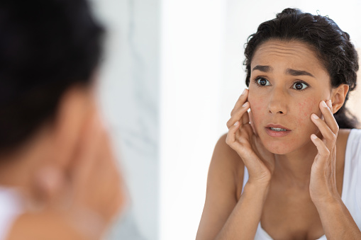 Atopic Skin Concept. Worried Young Woman Looking At Mirror And Touching Face, Unhappy Millennial Lady Suffering Dermatitis, Examining Irritation Signs While Standing In Bathroom At Home, Closeup