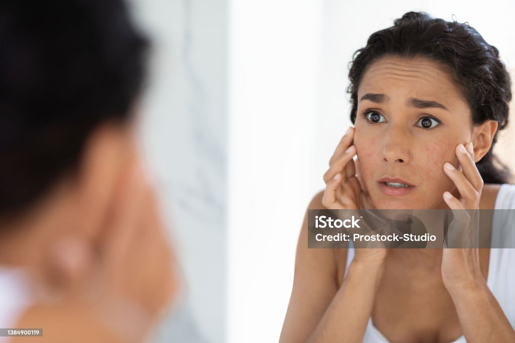 Atopic Skin Concept. Worried Young Woman Looking At Mirror And Touching Face Atopic Skin Concept. Worried Young Woman Looking At Mirror And Touching Face, Unhappy Millennial Lady Suffering Dermatitis, Examining Irritation Signs While Standing In Bathroom At Home, Closeup Women Stock Photo