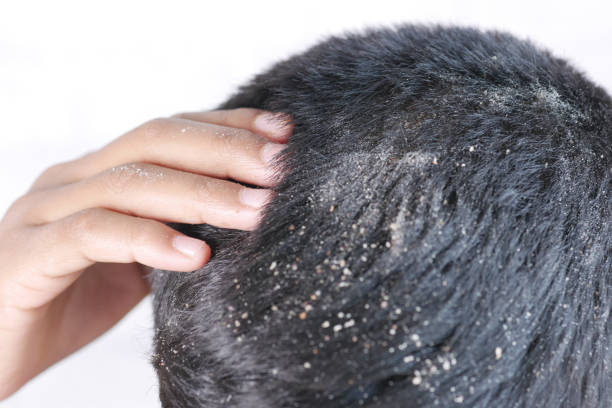 istock men with dandruff in his hair, closeup 1385270522