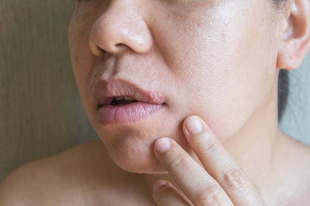 istock Close up a herpes simplex virus on lips women 1385279224