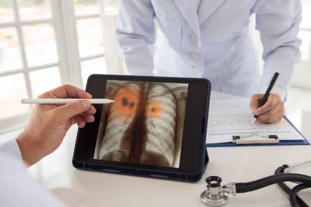 pneumonia or lung inflamed - x ray image radiologist examining using voice imagens e fotografias de stock