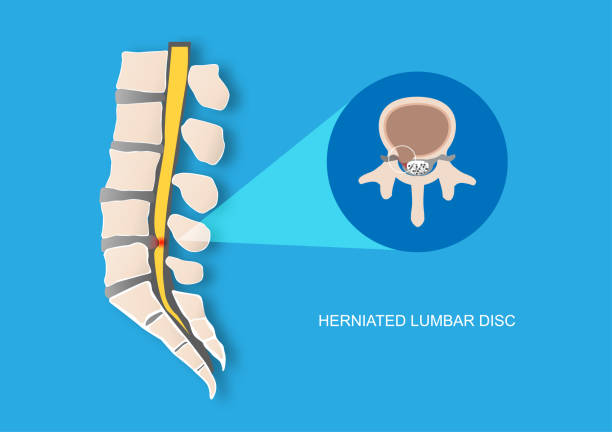 illustrazioni stock, clip art, cartoni animati e icone di tendenza di ernia del disco vertebrale lombare - disc break