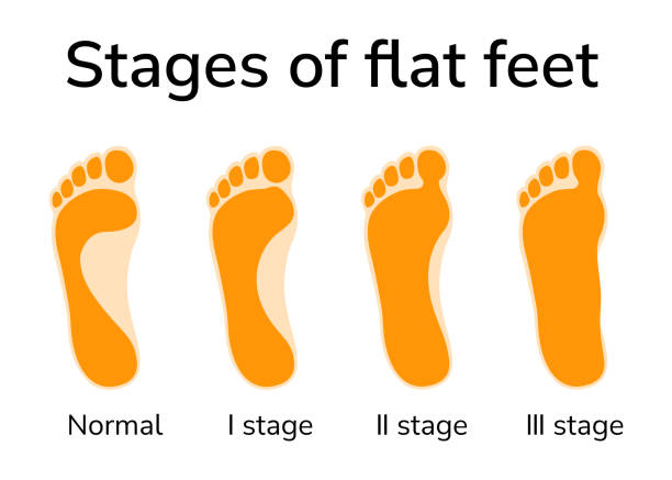 Stages of flat feet Illustration of three stages of flat feet. Four footprints depicted - normal position and stages of deformity pes planus stock illustrations