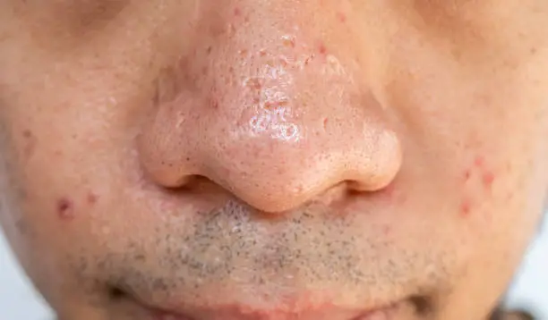 Nose pores are openings into the skin, where sebaceous glands produce and distribute the skin's natural oil.