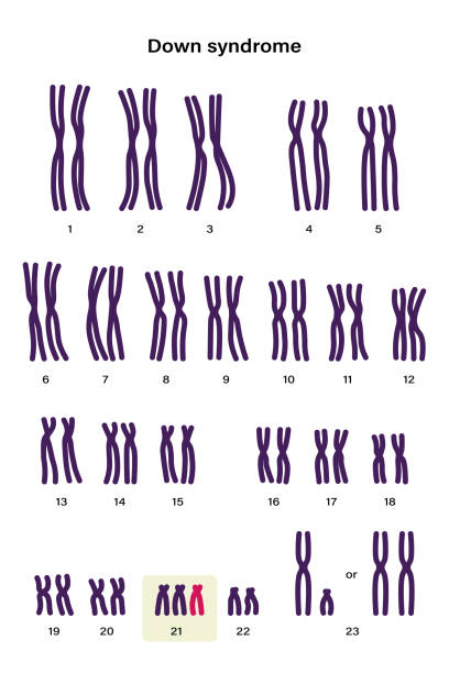 ダウン症のヒト核型.常染色体異常。ダウン症は、これらの染色�体の1つ、染色体21の余分なコピーを持っています。トリソミー 21.遺伝性疾患 - 染色体点のイラスト素材／クリップアート素材／マンガ素材／アイコン素材