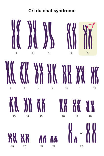 クリ・デュ・チャット症候群のヒト核型。常染色体異常。染色体5の一部が欠落しています - rare点のイラスト素材／クリップアート素材／マンガ素材／アイコン素材