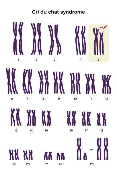 человеческий кариотип синдрома cri du chat. аутосомные аномалии. отсутствует кусок хромосомы 5 - rare stock illustrations